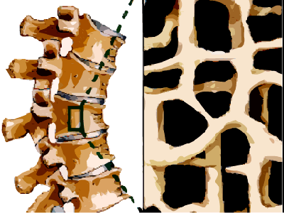 osteoporóza osteoporóza